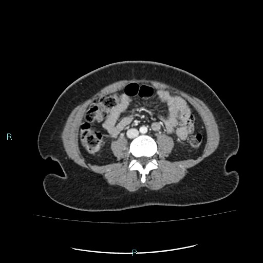 Acute bilateral pyelonephritis (Radiopaedia 37146-38881 Axial C+ portal venous phase 61).jpg