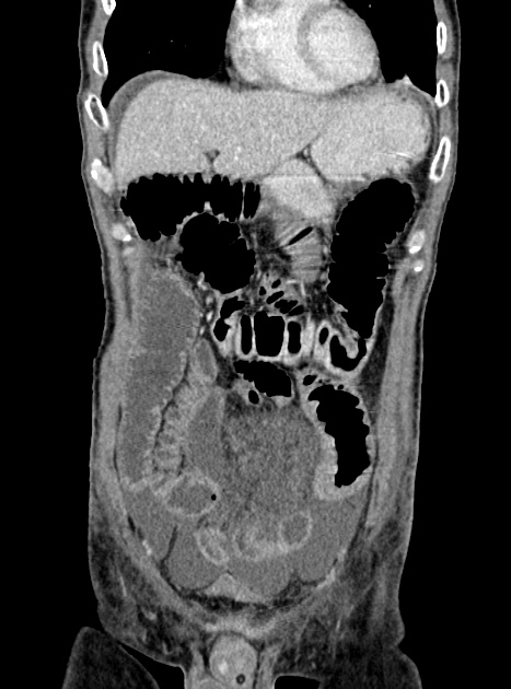 Acute bowel ischemia (Radiopaedia 87695-104114 Coronal C+ portal venous phase 127).jpg