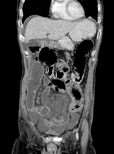 Acute bowel ischemia (Radiopaedia 87695-104114 Coronal C+ portal venous phase 131).jpg