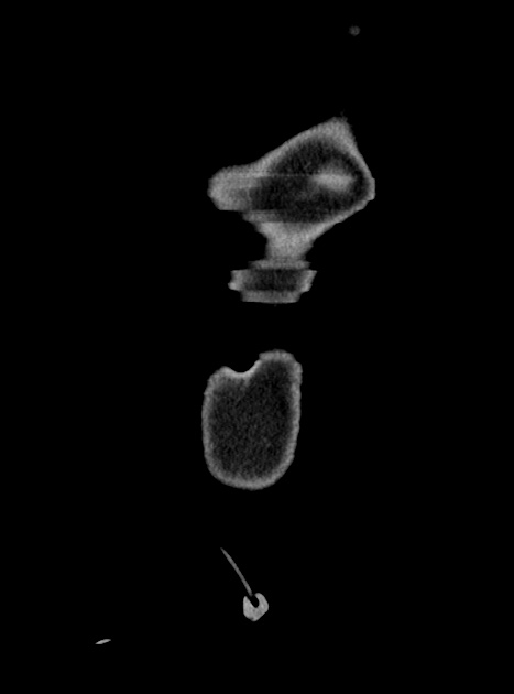 Acute bowel ischemia (Radiopaedia 87695-104114 Coronal C+ portal venous phase 51).jpg