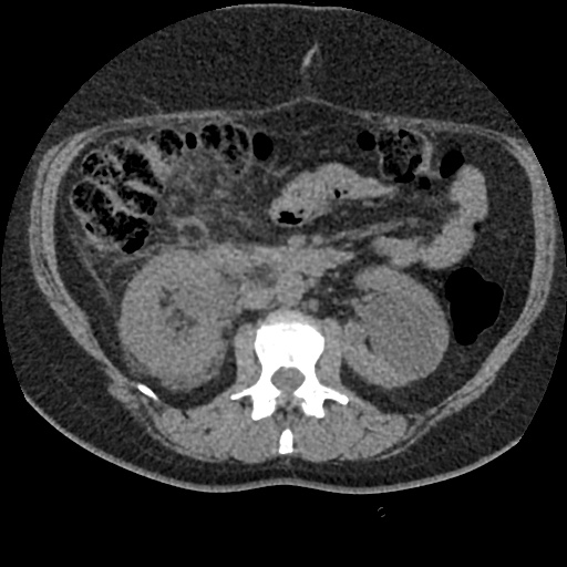 File:Acute cholecystitis and ureteric colic (Radiopaedia 42330-45444 Axial prone 41).jpg