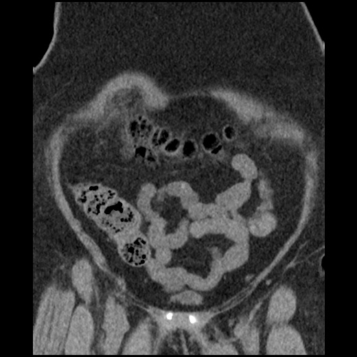 Acute cholecystitis and ureteric colic (Radiopaedia 42330-45444 Coronal prone 26).jpg