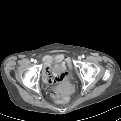 Acute cholecystitis with contained perforation (Radiopaedia 47328-51907 Axial C+ portal venous phase 68).png