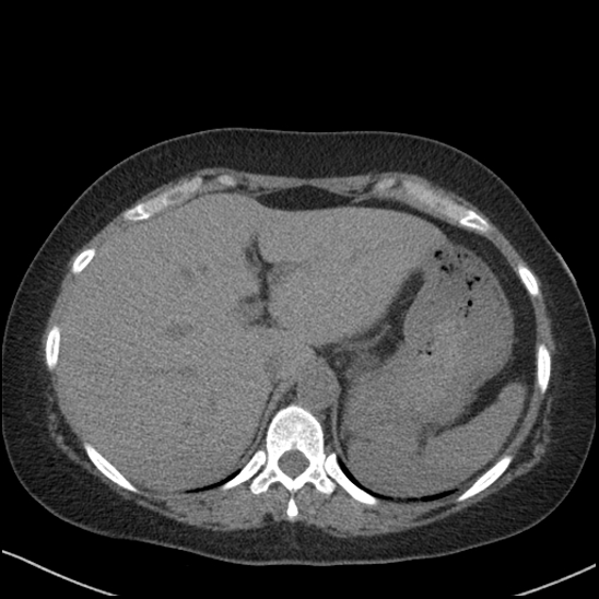 Acute colonic hemorrhage in ulcerative colitis (Radiopaedia 77415-89538 Axial non-contrast 26).jpg
