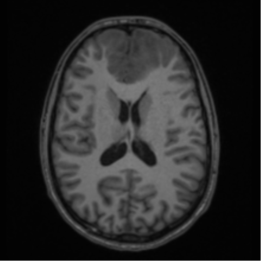 Acute disseminated encephalomyelitis (ADEM) (Radiopaedia 65319-74349 Axial T1 39).png