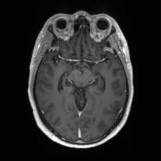 Acute disseminated encephalomyelitis (ADEM) (Radiopaedia 65319-74350 Axial T1 C+ 24).png
