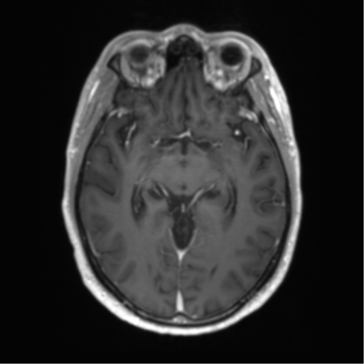Acute disseminated encephalomyelitis (ADEM) (Radiopaedia 65319-74350 Axial T1 C+ 25).png