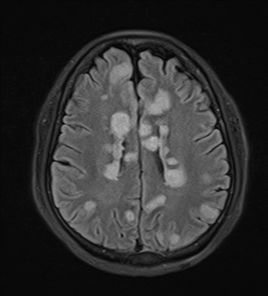 File:Acute disseminated encephalomyelitis (Radiopaedia 37253-39033 Axial FLAIR 18).jpg