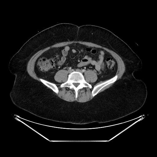 Acute diverticulitis - transverse colon (Radiopaedia 87063-103327 Axial C+ portal venous phase 104).jpg