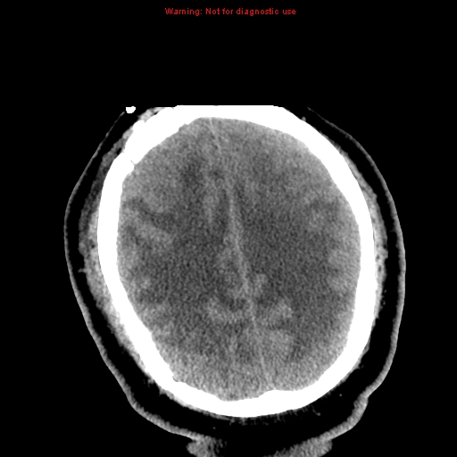 File:Acute hemorrhagic leukoencephalitis (Radiopaedia 14076-72275 Axial non-contrast 31).jpg
