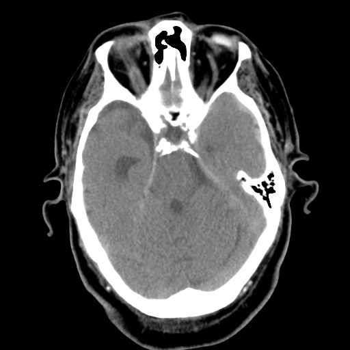 Acute hemorrhagic stroke (Radiopaedia 17507-17223 Axial non-contrast 18).jpg