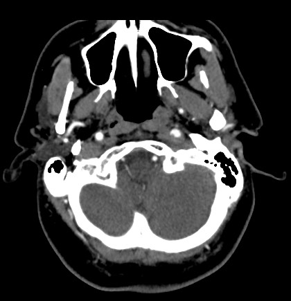 Acute internal carotid artery dissection (Radiopaedia 53541-59630 Axial C+ arterial phase 8).jpg