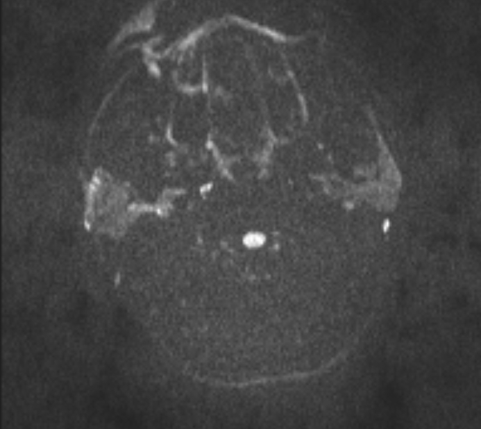 Acute ischemic stroke - posterior circulation territory (Radiopaedia 77670-89880 Axial DWI 47).jpg