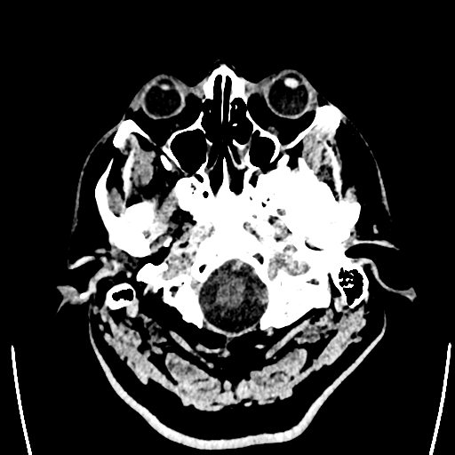 Acute left middle cerebral artery territory ischemic stroke (Radiopaedia 35688-37223 Axial non-contrast 4).png