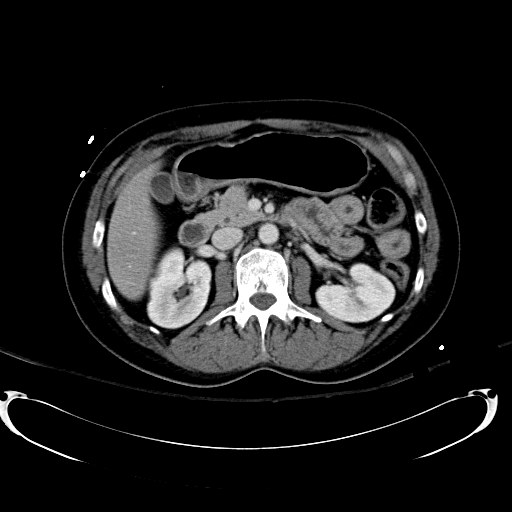 File:Acute myocardial infarction in CT (Radiopaedia 39947-42415 Axial C+ portal venous phase 50).jpg