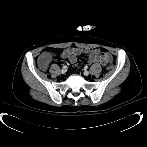 Acute myocardial infarction in CT (Radiopaedia 39947-42415 Axial C+ portal venous phase 95).jpg