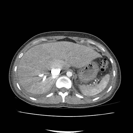 Acute myocarditis (Radiopaedia 55988-62613 Axial C+ portal venous phase 16).jpg