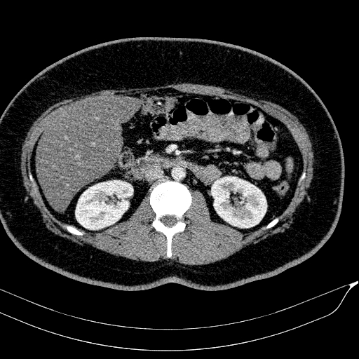 Acute on chronic pancreatitis (Radiopaedia 80902-94423 Axial C+ portal venous phase 81).jpg
