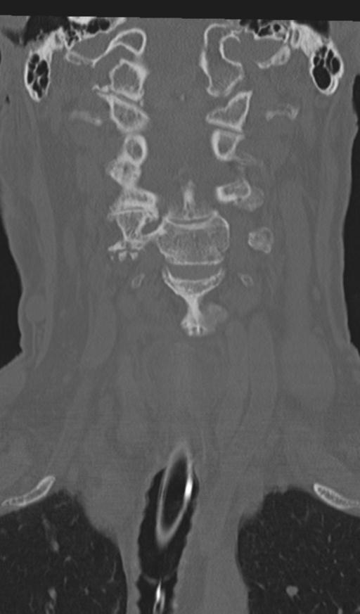 Acute on chronic subdural hematoma and thoracic vertebral injury in a multitrauma patient (Radiopaedia 31698-32619 Coronal bone window 19).jpg