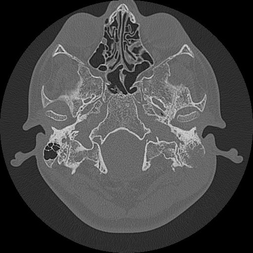 Acute otomastoiditis and Bezold abscess (Radiopaedia 88184-104786 Axial bone window 19).jpg