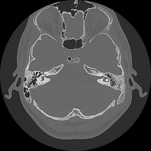 Acute otomastoiditis and Bezold abscess (Radiopaedia 88184-104786 Axial bone window 37).jpg