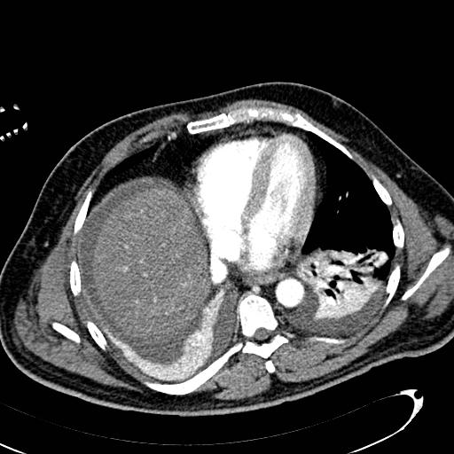 File:Acute pancreatic necrosis (Radiopaedia 13560-13486 Axial C+ portal venous phase 13).jpg