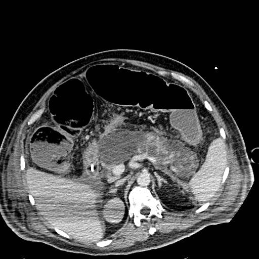 Acute pancreatic necrosis (Radiopaedia 13560-18501 Axial C+ portal venous phase 43).jpg