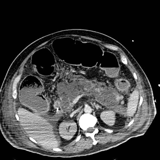 Acute pancreatic necrosis (Radiopaedia 13560-18501 Axial C+ portal venous phase 48).jpg