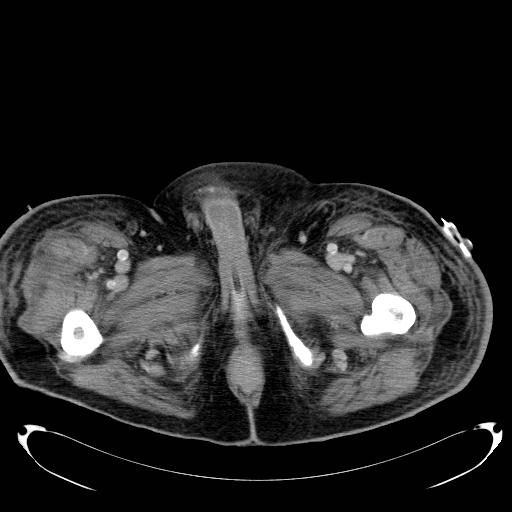 Acute pancreatic necrosis (Radiopaedia 13560-18503 Axial C+ portal venous phase 93).jpg