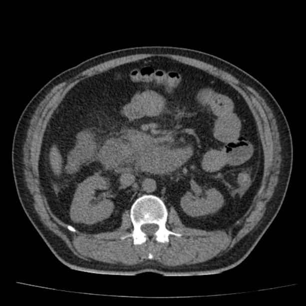 Acute pancreatitis (Radiopaedia 26663-26813 Axial non-contrast 46).jpg