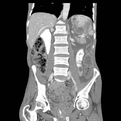 File:Acute pancreatitis (Radiopaedia 50213-55558 Coronal C+ portal venous phase 26).jpg