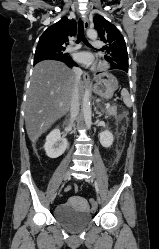 Acute pancreatitis (Radiopaedia 80007-93285 Coronal C+ portal venous phase 71).jpg