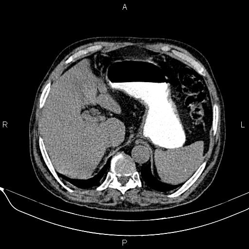 Acute pancreatitis (Radiopaedia 85146-100701 Axial non-contrast 29).jpg