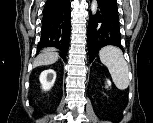 Acute pancreatitis (Radiopaedia 85146-100701 Coronal C+ portal venous phase 60).jpg