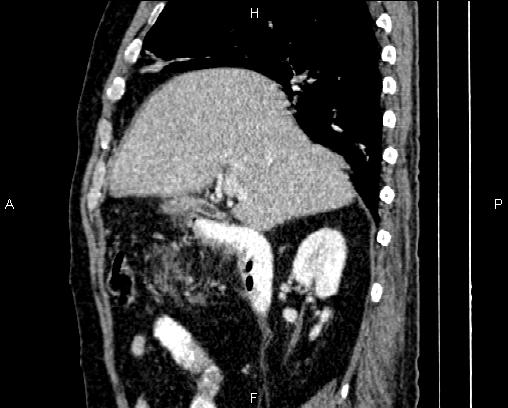 File:Acute pancreatitis (Radiopaedia 85146-100701 Sagittal C+ portal venous phase 28).jpg