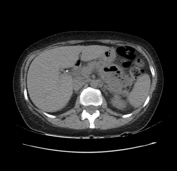 File:Acute pancreatitis - Balthazar E - post ERCP (Radiopaedia 27562-27772 Axial non-contrast 18).png