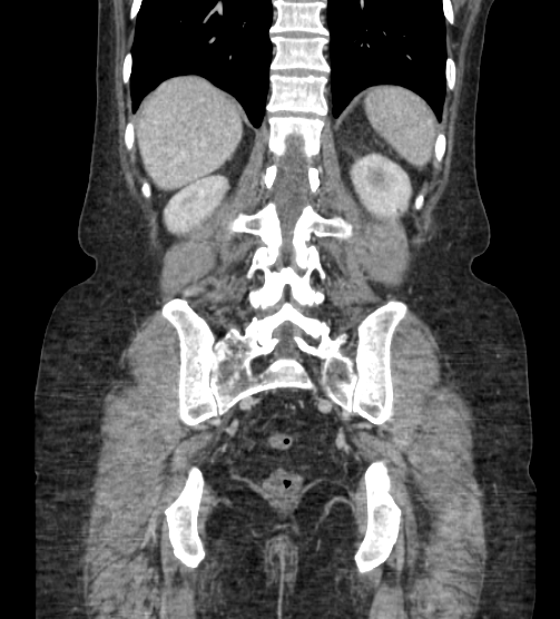 Acute pancreatitis - Balthazar E - post ERCP (Radiopaedia 27562-27772 Coronal C+ portal venous phase 68).png