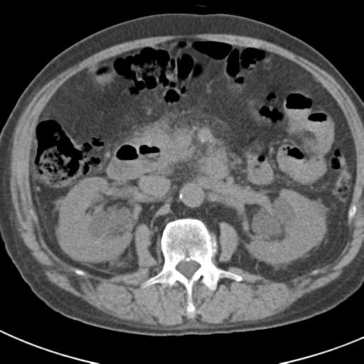 File:Acute pancreatitis and walled-off necrosis (Radiopaedia 29888-30403 Axial non-contrast 30).jpg