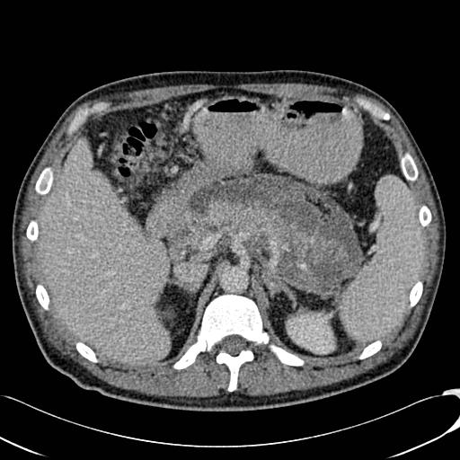File:Acute pancreatitis with walled off pancreatic necrosis (Radiopaedia 6438-7797 Axial C+ portal venous phase 3).jpg