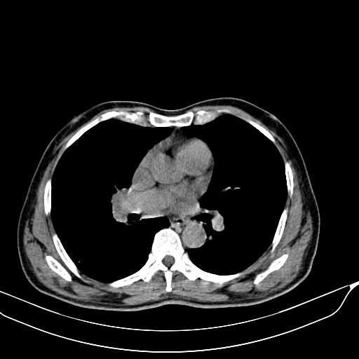 File:Acute pulmonary embolism (Radiopaedia 69510-79390 Axial non-contrast 19).jpg