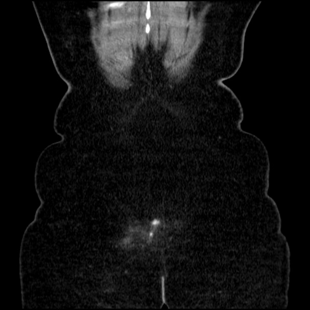Acute pyelonephritis (Radiopaedia 33397-34434 Coronal renal parenchymal phase 71).jpg