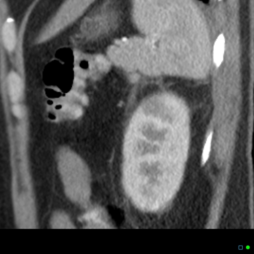 File:Acute pyelonephritis and emphysematous pyonephrosis (Radiopaedia 27893-28128 renal cortical phase 3).jpg