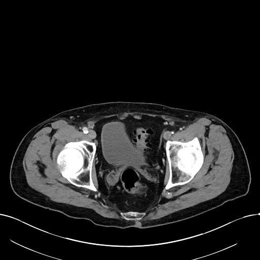 Acute renal infarction (Radiopaedia 59375-66736 Axial C+ portal venous phase 107).jpg
