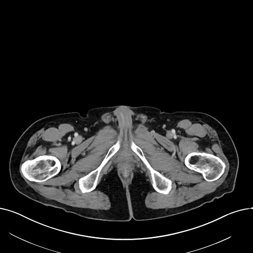 Acute renal infarction (Radiopaedia 59375-66736 Axial C+ portal venous phase 129).jpg