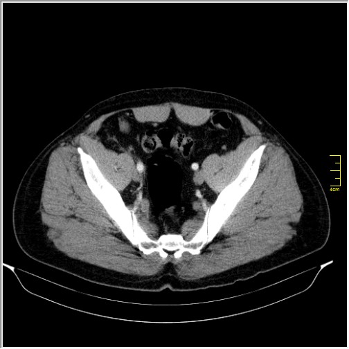 Acute right sided diverticulitis (Radiopaedia 65249-74268 Axial C+ portal venous phase 66).JPG