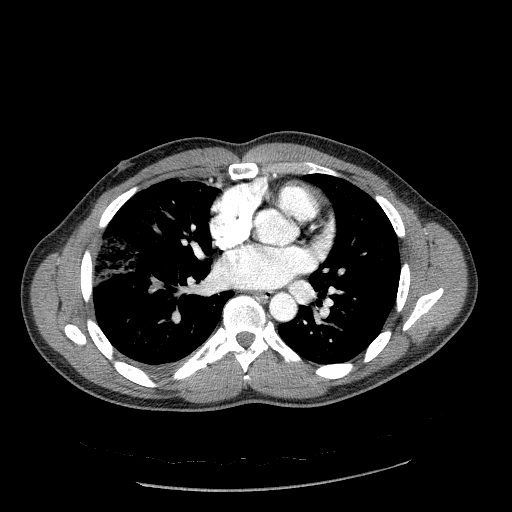 File:Acute segmental pulmonary emboli and pulmonary infarction (Radiopaedia 62264-70444 Axial C+ CTPA 65).jpg