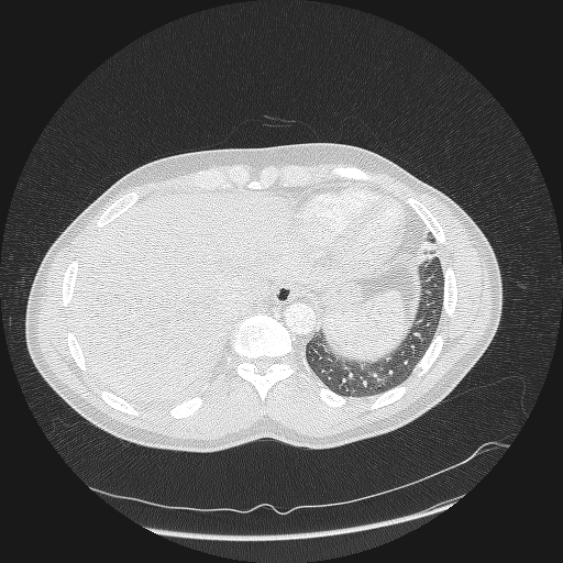Acute segmental pulmonary emboli and pulmonary infarction (Radiopaedia 62264-70444 Axial lung window 166).jpg