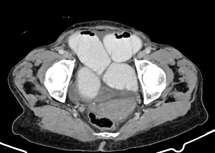 Acute small bowel (ileal) volvulus (Radiopaedia 71740-82139 Axial C+ portal venous phase 179).jpg