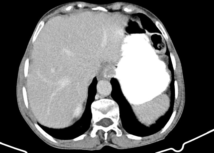 Acute small bowel (ileal) volvulus (Radiopaedia 71740-82139 Axial C+ portal venous phase 50).jpg