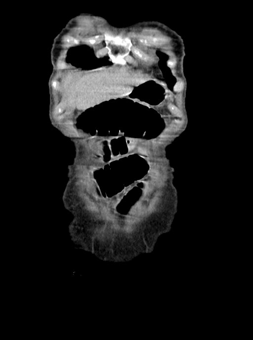 Acute small bowel (ileal) volvulus (Radiopaedia 71740-82139 Coronal C+ portal venous phase 13).jpg